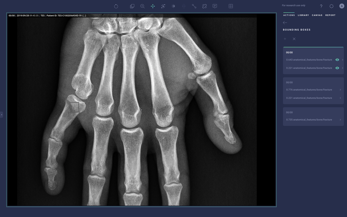 Arterys Chest/MSK Pathology Detection: Hand