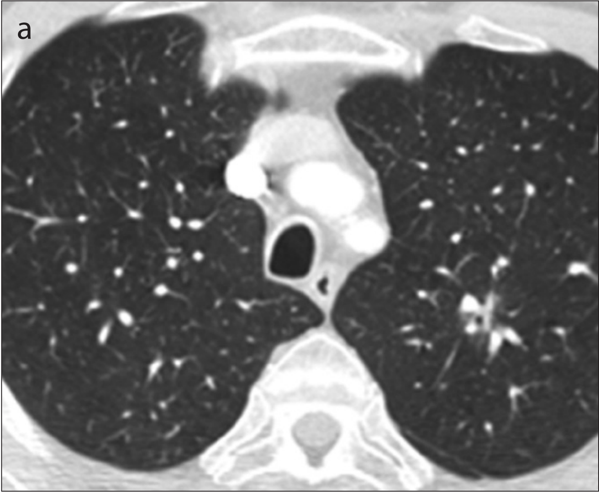 Missed Lung Cancer Patient 1 (63yo patient with lung cancer) Panel A: Lung window show a small and poorly defined close close to vessels in the right lung.