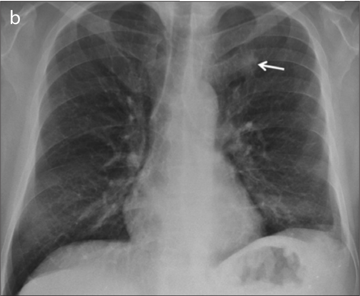 Missed Lung Cancer Patient 1 (63yo patient with lung cancer) Panel B: Chest x-ray obtained a few years later shows a nodule