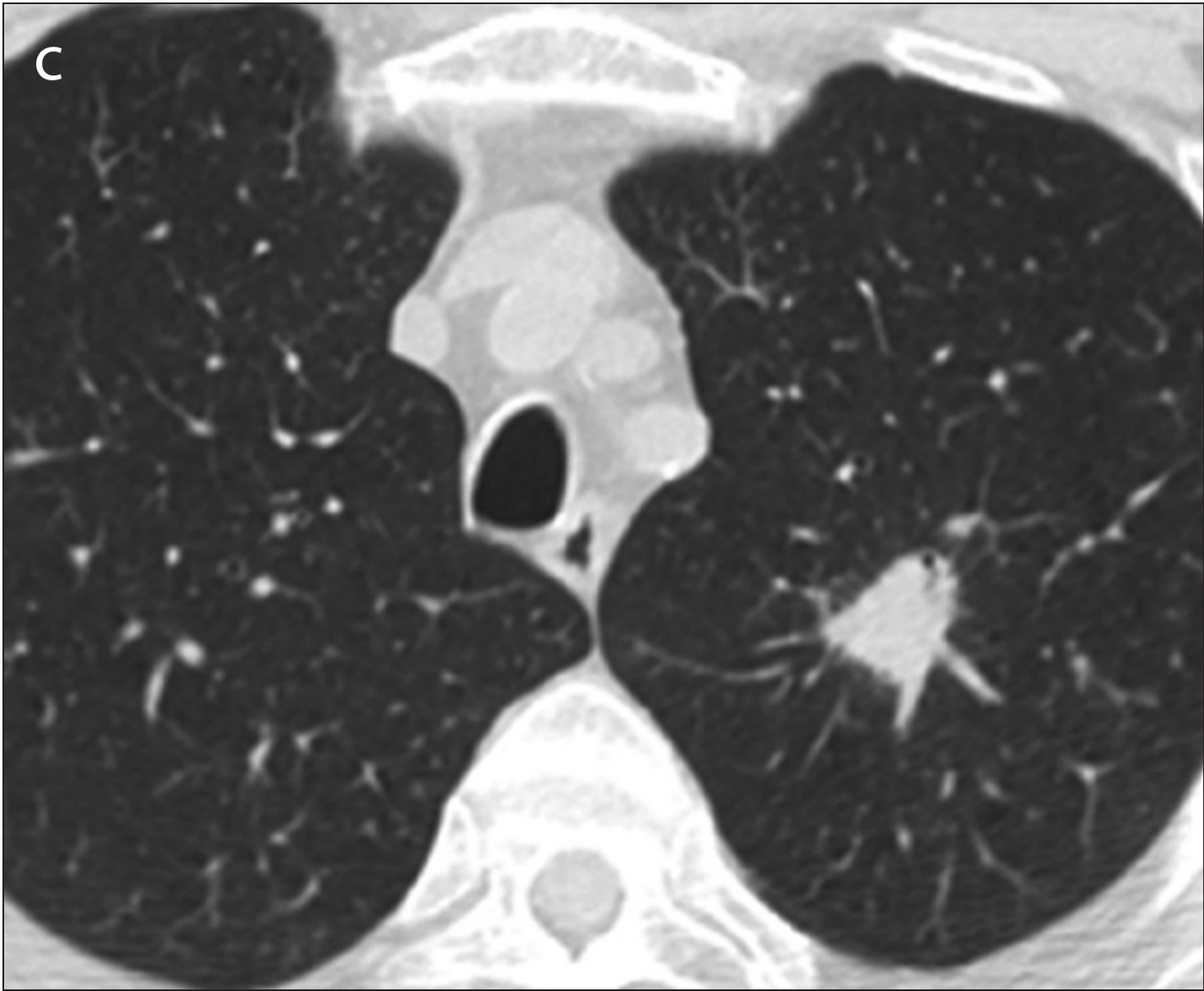 Missed Lung Cancer Patient 1 (63yo patient with lung cancer) Panel C: Coronal CT image shows a 2cm nodule (larger than the previous scan)