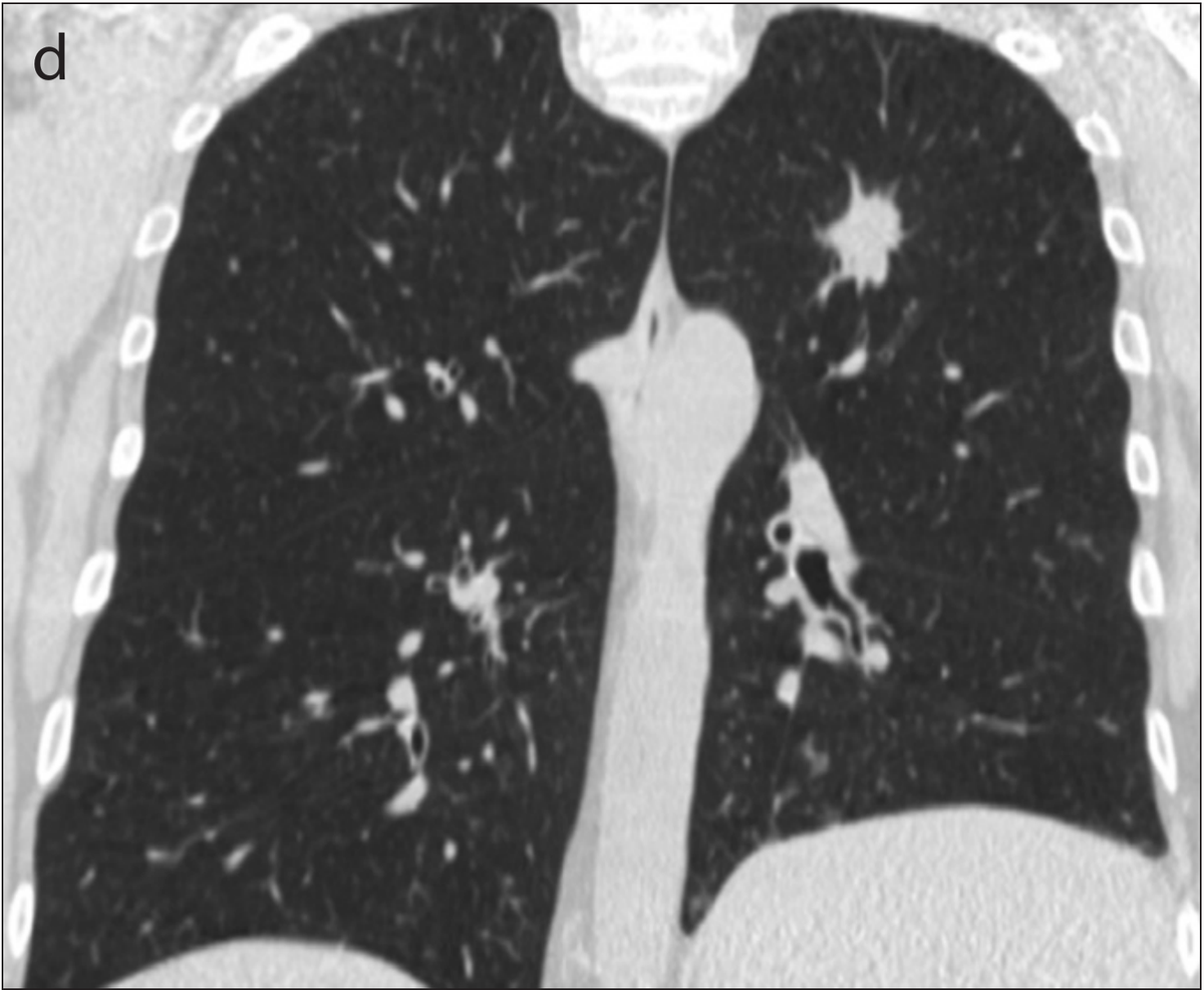 Missed Lung Cancer Patient 1 (63yo patient with lung cancer) Panel D: Coronal CT image shows a 2cm nodule (larger than the previous scan)