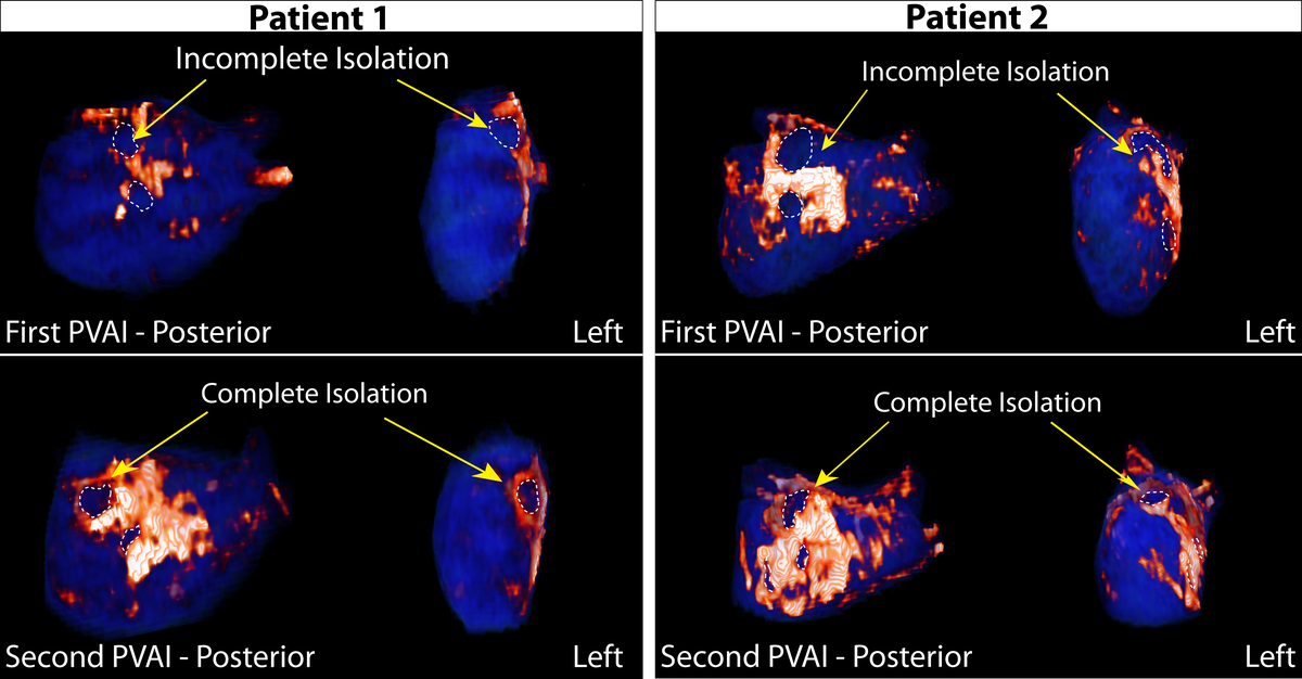 Atrial Fibrillation: Assessing Patient Response to Ablation