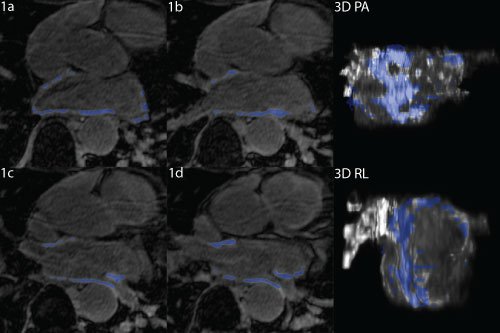 Atrial Fibrillation: Building 3D Models from 2D MRI (Shows Ablation Scarring)