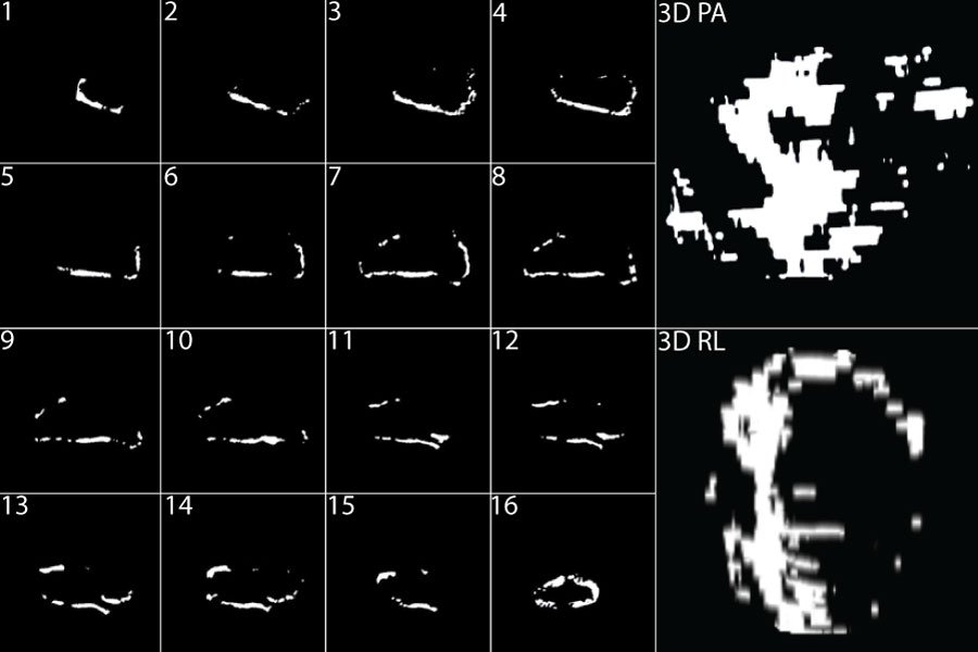 Atrial Fibrillation: Building 3D Models from 2D MRI (Segmentation Masks)