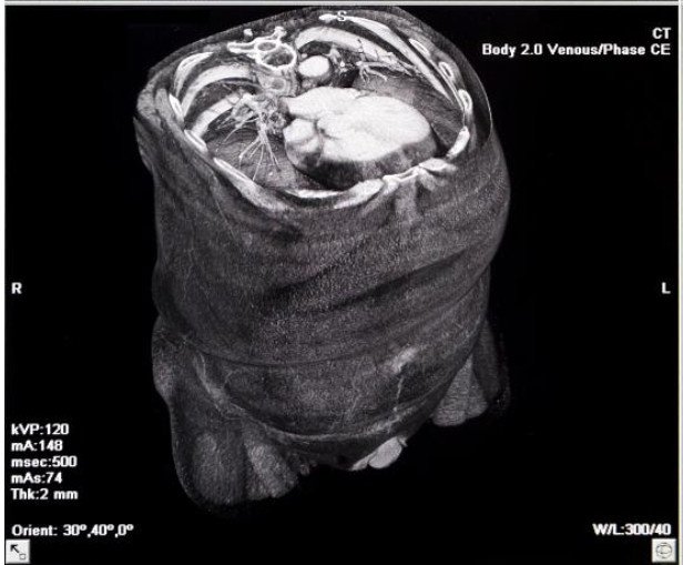 Three Dimensional Volume Created from Stacked CT Images