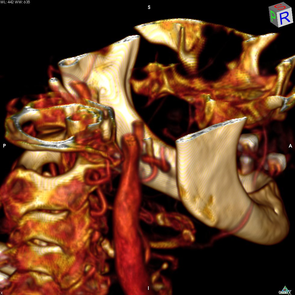 Anatomic Models (3D): Skull and Neck