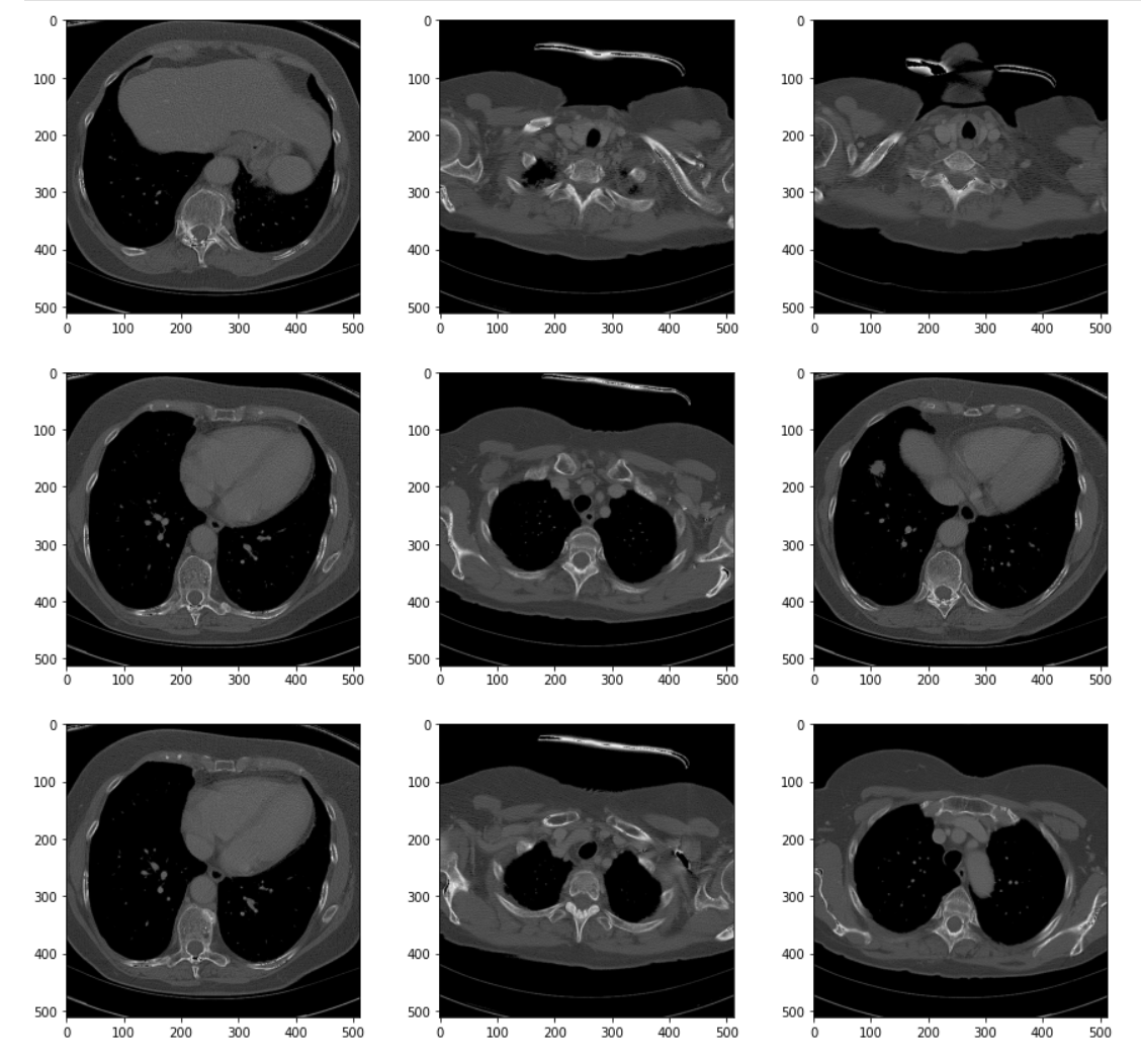 Figure: Series of Images from a Processed (Contrast Stretching) Chest CT Scan