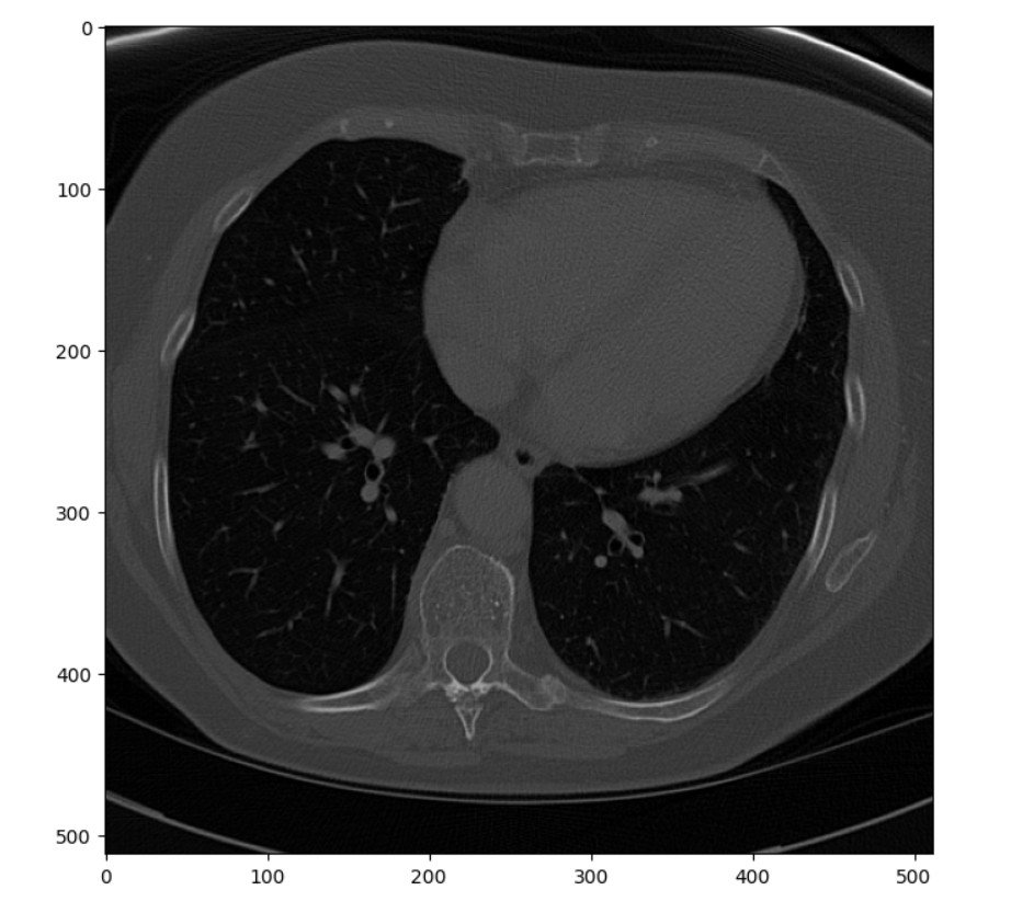 Figure: Unenhanced Slice from a CT Scan