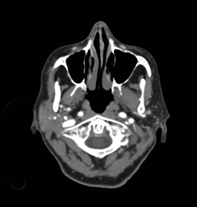 CT: Head Slice 1