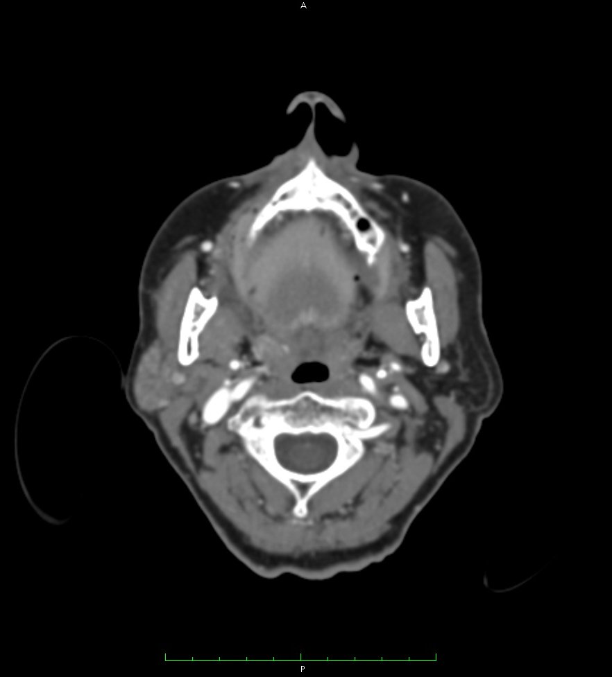 CT: Head Slice 2