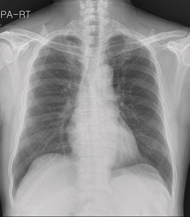 Radiology/DCNN Patient 1 (62yo man with adenocarcinoma) Panel A: Without assistance from DLNN, three radiologists interpreted as a normal.