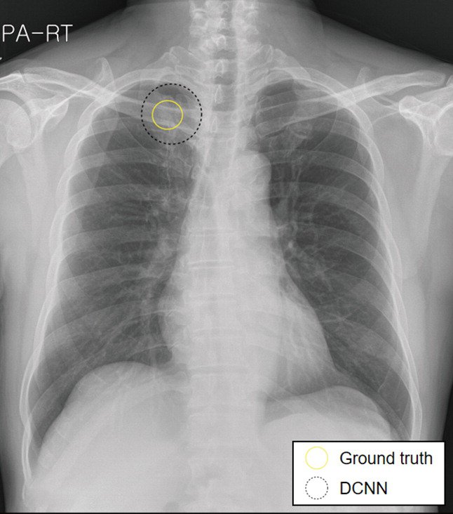 Radiology/DCNN Patient 1 (62yo man with adenocarcinoma) Panel B: With assistance from the DLNN, all readers were able to identify a true nodule.