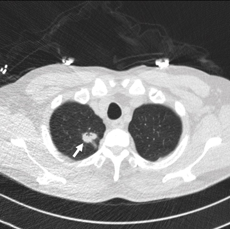 Radiology/DCNN Patient 1 (62yo man with adenocarcinoma) Panel C: Axial CT shows a 25mm solid mass in the upper right lobe of the lung.