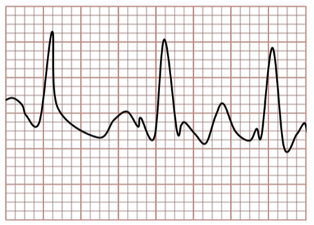 EKG Trace: Atrial Fibrillation