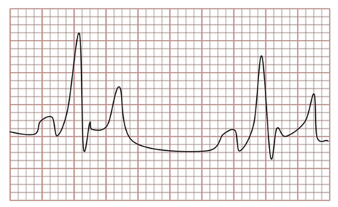 EKG Trace: EPR