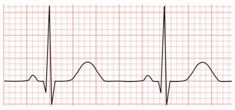 EKG Trace: Healthy