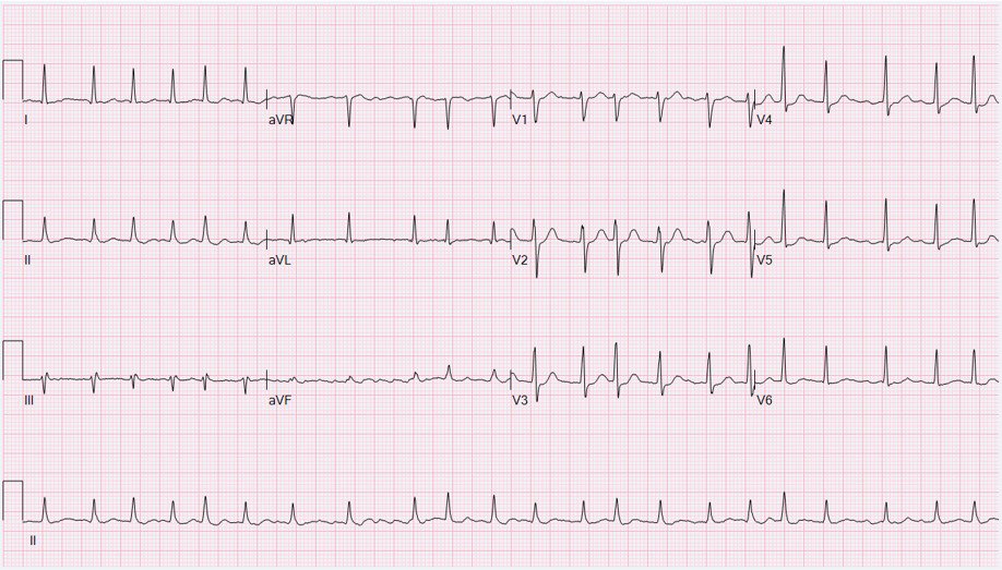 EKG: Atrial Fibrillation