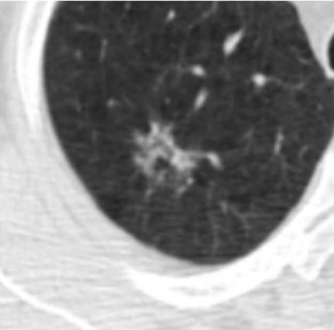 Google 3D Lung Cancer Detection Patient 1 (patient with lung cancer) Panel B: Cropped volume of the tumor submitted to the cancer risk prediction model.