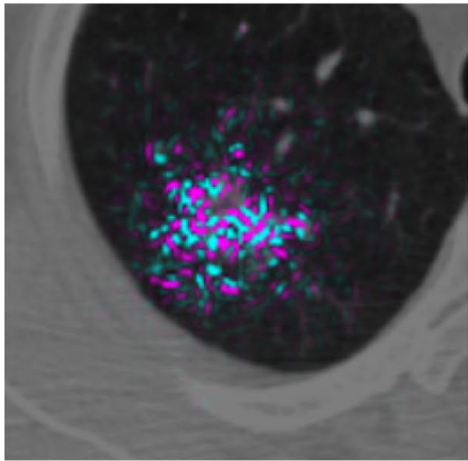 Google 3D Lung Cancer Detection Patient 1 (patient with lung cancer) Panel D: Detail of the model positive (magenta) and negative (blue) contributors.