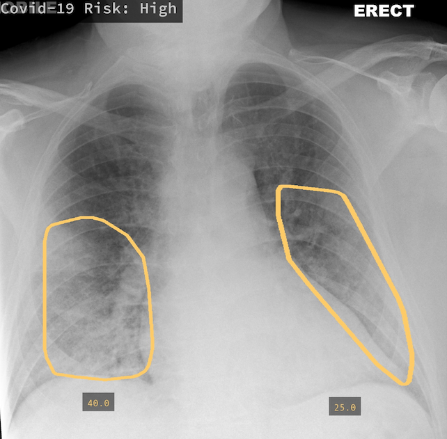 Qure.AI: COVID-19 Risk Assessment (High Risk)