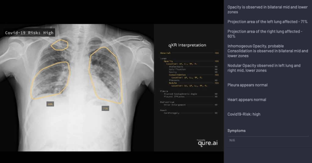 Qure.AI: COVID-19 Risk Assessment With Interpretation and Radiology Notes (High Risk)