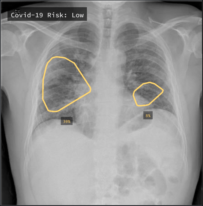 Qure.AI: COVID-19 Risk Assessment (Low Risk)