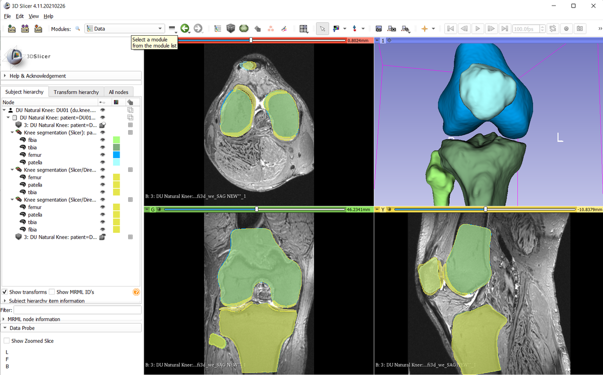 Sonador 3D: Knee Models in 3D Slicer