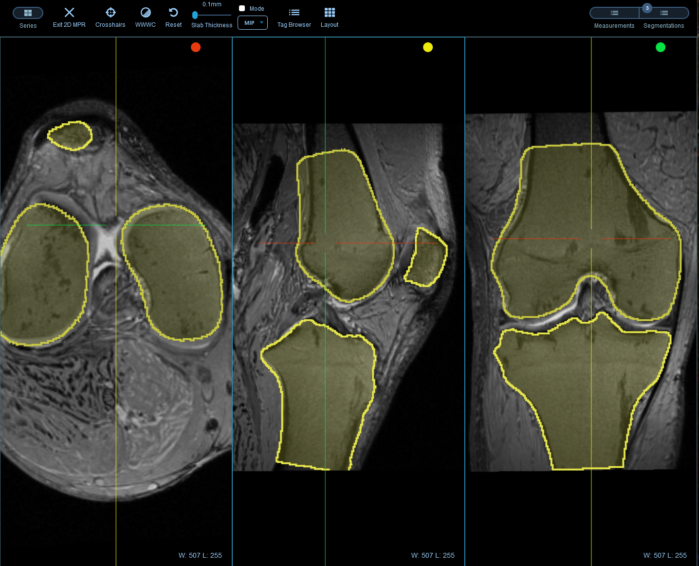 Sonador Viewer: Multi-planar reconstruction (MPR with segmentations)