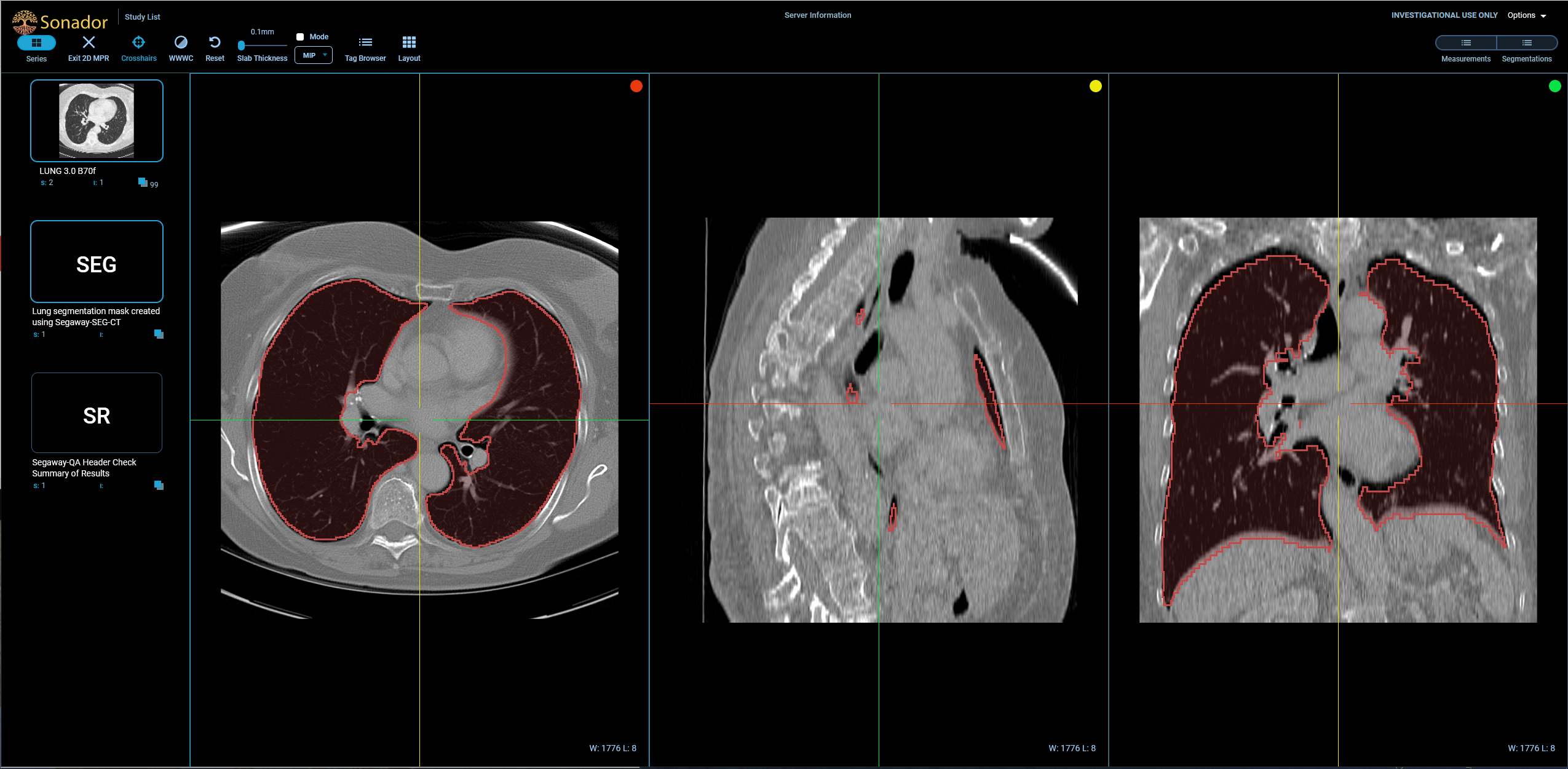 Sonador UI: Multi-planar reconstruction in OHIF