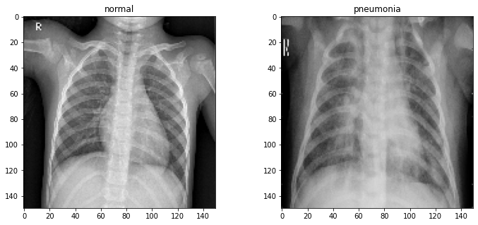 X-Ray Pneumonia Examples